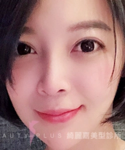 台北綺麗嘉療程|重修雙眼皮