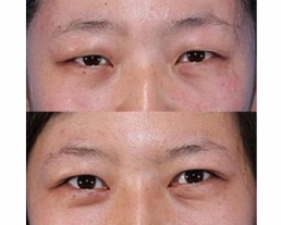 手術案例|微創縫線式雙眼皮手術和不留疤痕的眼頭整型