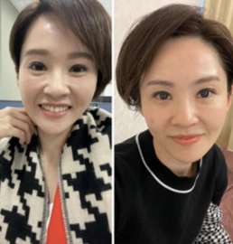 手術案例|FLX鳳凰電波~與時光逆行~停留在少女的輪廓線!