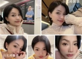 手術案例|MONALISA 玻尿酸治療後美美分享