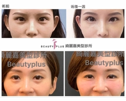 手術案例|徹底向涙溝黑眼圈說bye-bye，膠原蛋白稚齡針擺脫熊貓眼