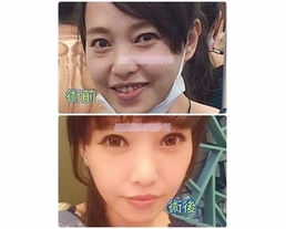 手術案例|關於我的眼袋淚溝血淚史!!