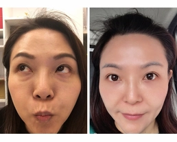 手術案例|眼袋手術分享-挑戰10年前照片妳敢嗎?
