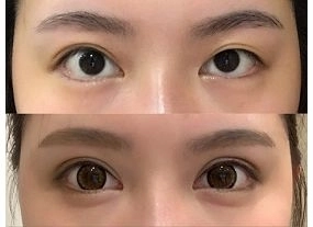 手術案例|我終於告別三白眼之第二次雙眼皮找對醫師一勞永逸