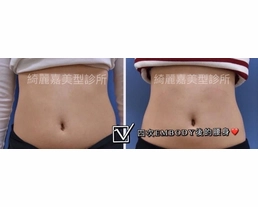 手術案例|懶人也能輕鬆GET腹肌!! 跟女神徐若瑄一起腹肌ROCK!!