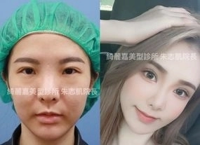 手術案例|雙眼皮+提眼肌+開眼頭+開眼尾→雙眸放大有神!變身甜心教主!