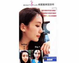 手術案例|謝謝朱志凱院長微整精雕讓我美美呈現高挺鼻梁!