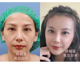 手術案例|眼袋內開脂肪位移手術,貴族手術,自體脂肪填額頭夫妻宮