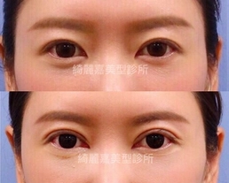手術案例|永逸美女電眼進化史 30天全紀錄~術前術後全能待美包大公開!!