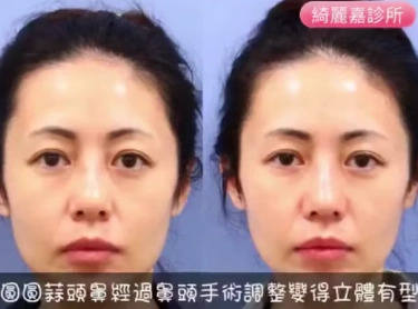 縮鼻頭手術~美女馬上展現立體美!!