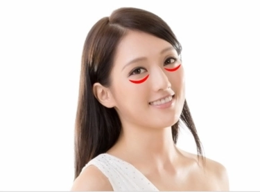 補淚溝失敗變眼袋,想自殺! 補淚溝,除眼袋請大家小心!