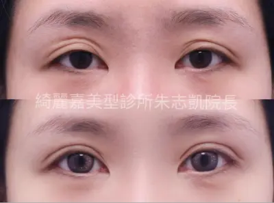 重修雙眼皮案例