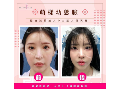 幼態臉(縮人中、微笑唇)