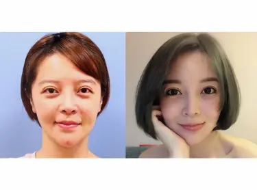 重修雙眼皮（綺麗嘉診所-朱志凱院長）