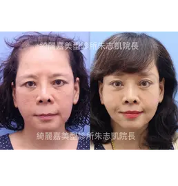 手術案例|多層次整合式臉部年輕化