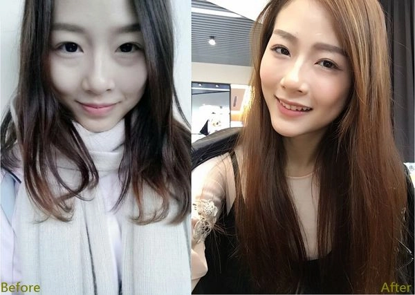 美麗見證割眼袋 美麗見證割眼袋