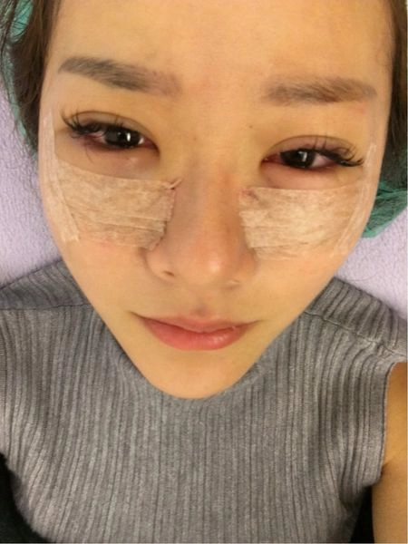 美麗見證割眼袋 美麗見證割眼袋