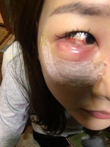 美麗見證割眼袋 割眼袋見證