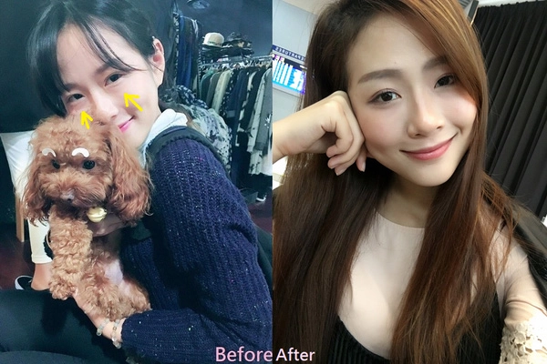 美麗見證割眼袋 美麗見證割眼袋