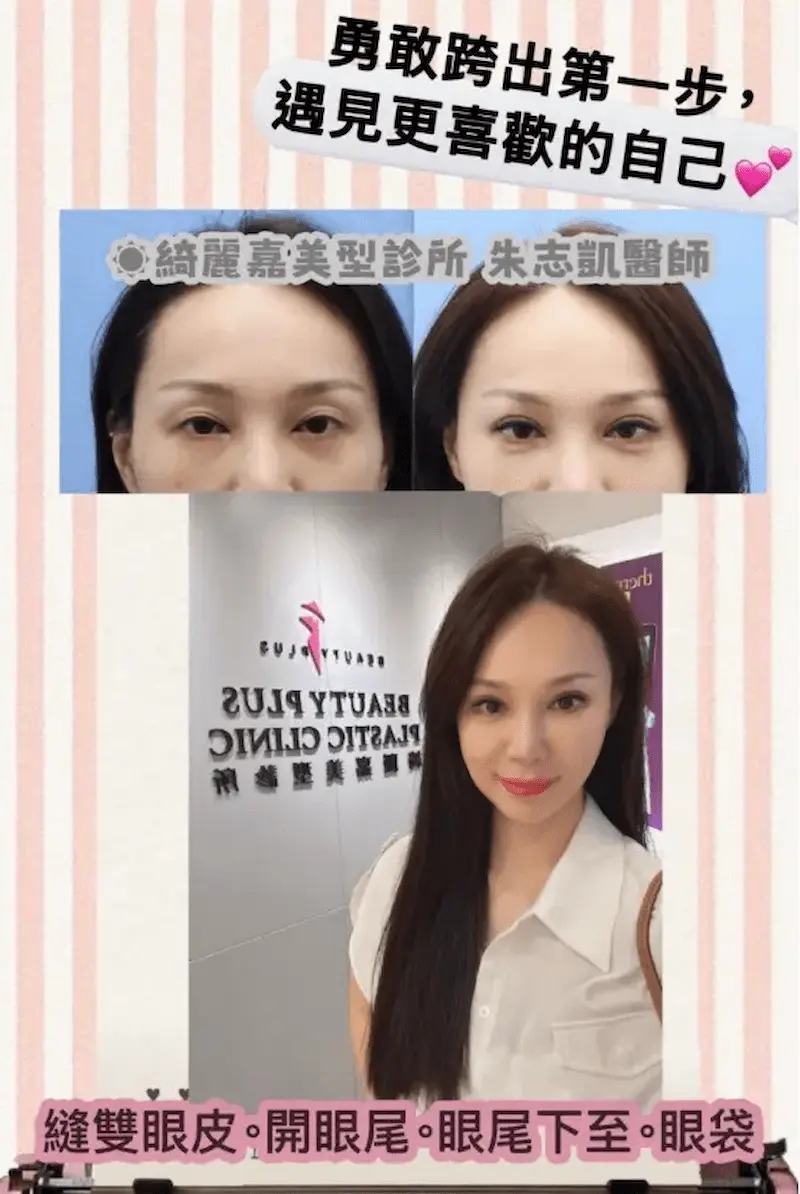 眼部複合式手術 消除黑眼圈,法令紋,微笑唇手術,縮鼻頭