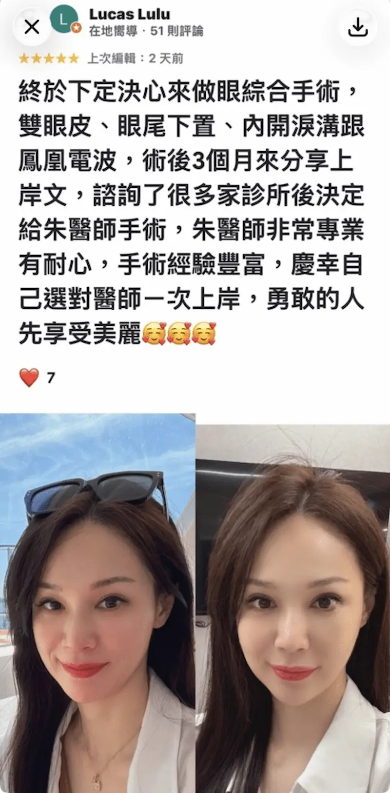 縫雙眼皮
