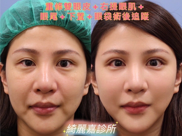開眼尾及下置