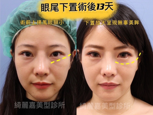 開眼頭、眼尾下置