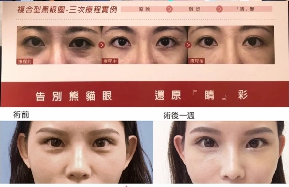 黑眼圈bye4