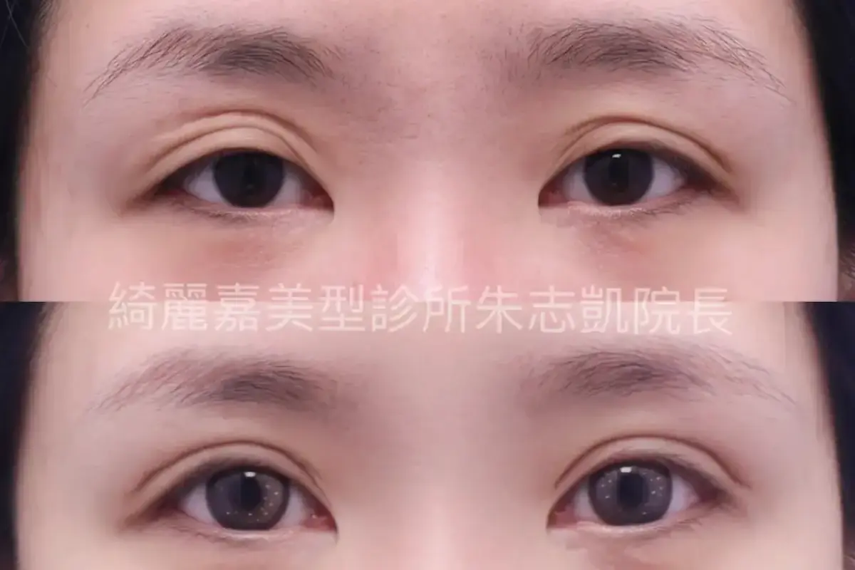 重修雙眼皮手術案例三