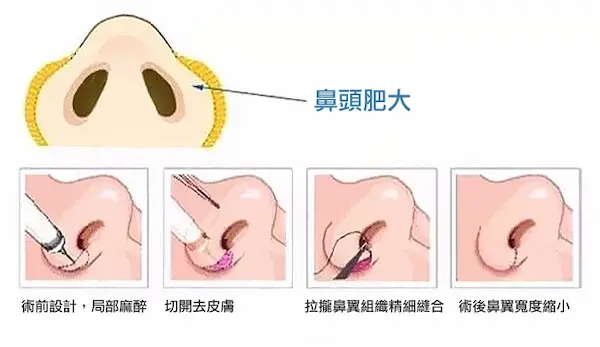 縮鼻翼手術-鼻頭肥大說明