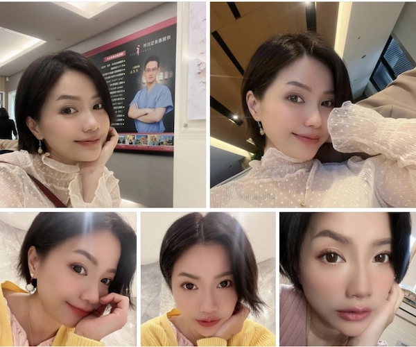 玻尿酸治療見證
