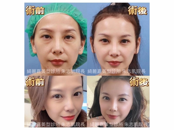 貴族手術見證