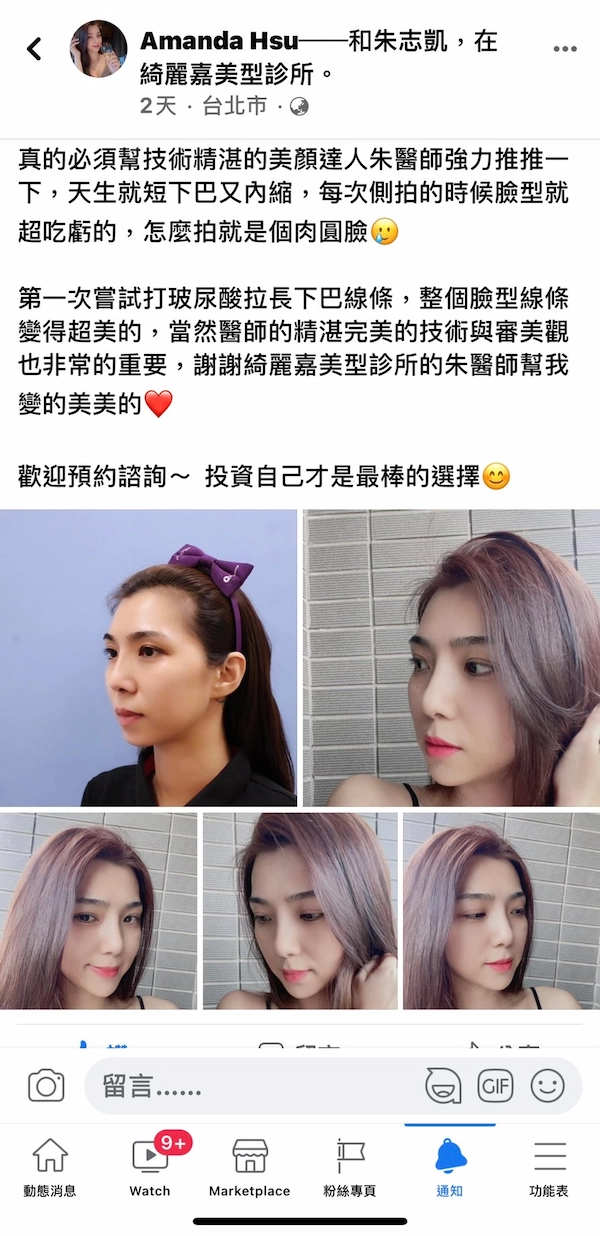 玻尿酸立體美
