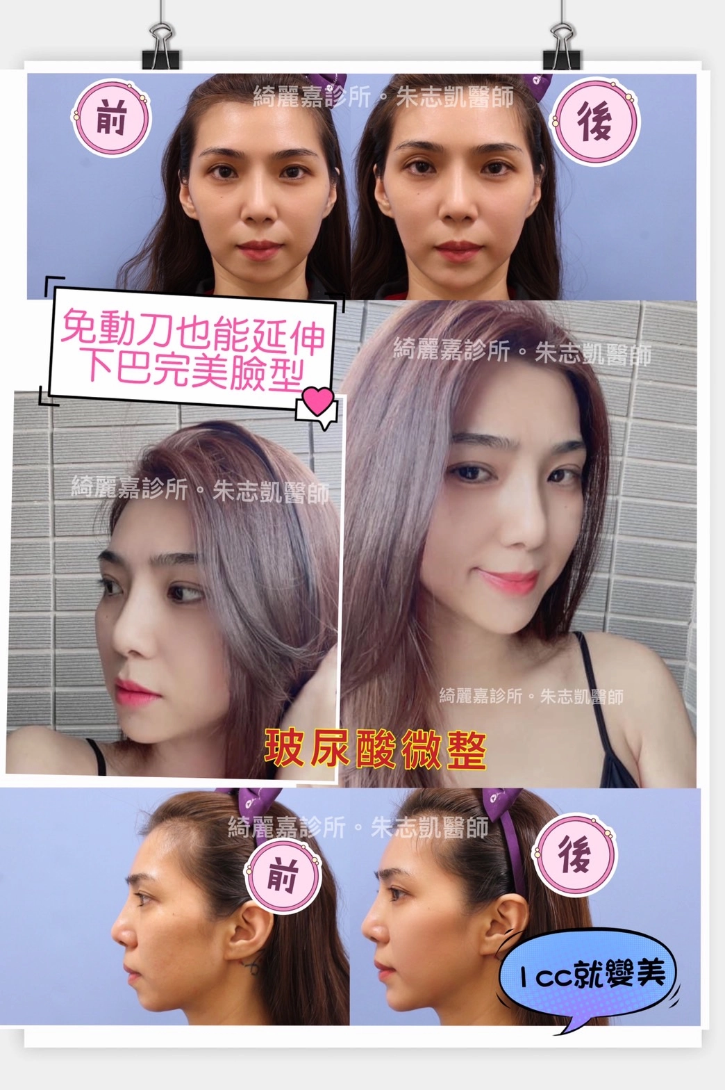 玻尿酸微整見證