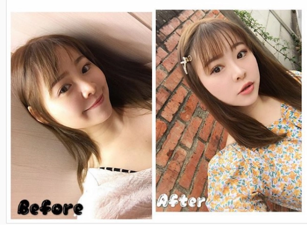 肉毒消咀嚼肌見證