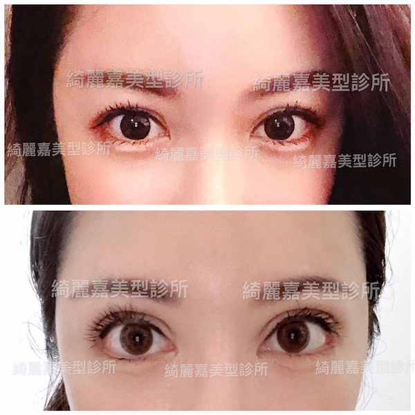 重修美眸見證