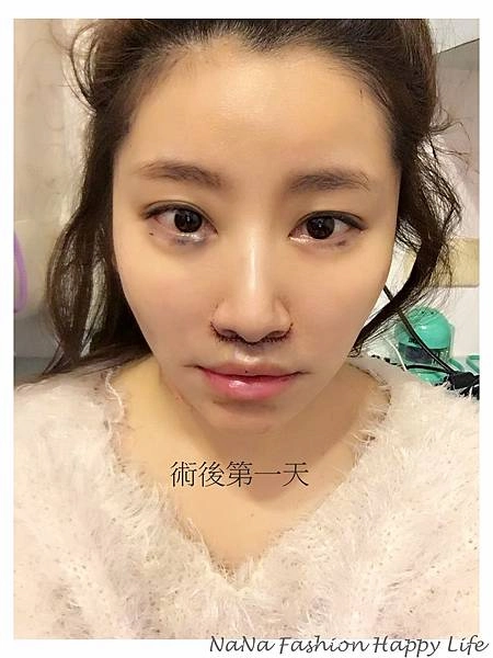 縮人中手術見證