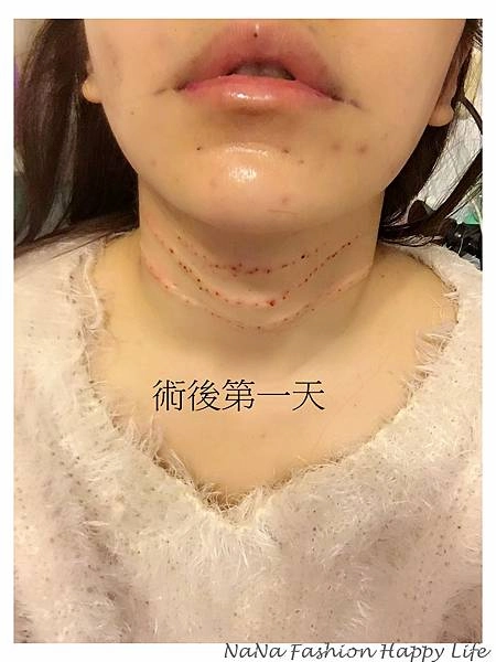 縮人中手術見證