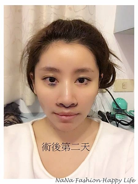 縮人中手術見證