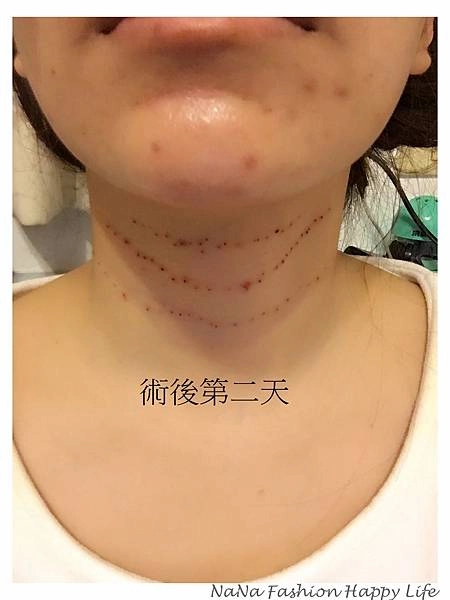 縮人中手術見證