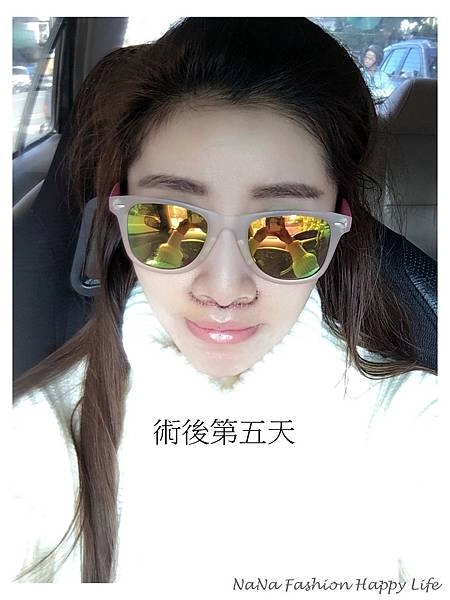 縮人中手術見證