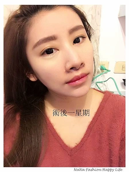 縮人中手術見證