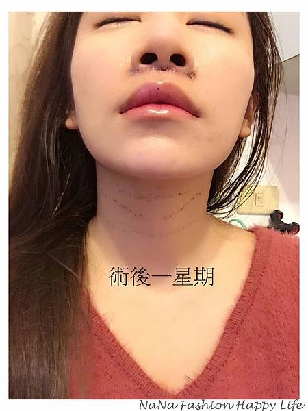 縮人中手術見證