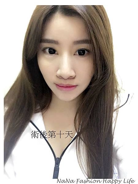 縮人中手術見證