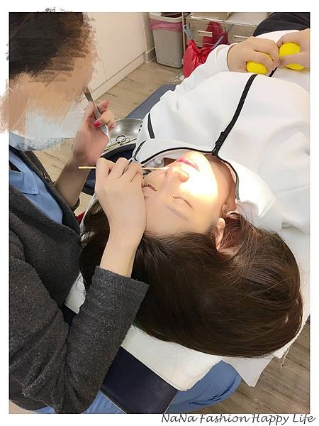 縮人中手術見證