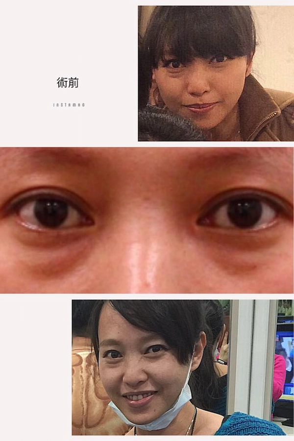 眼袋淚溝見證
