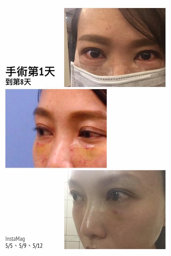 眼袋淚溝見證