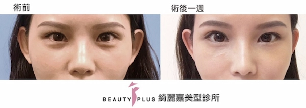 稚齡針見證