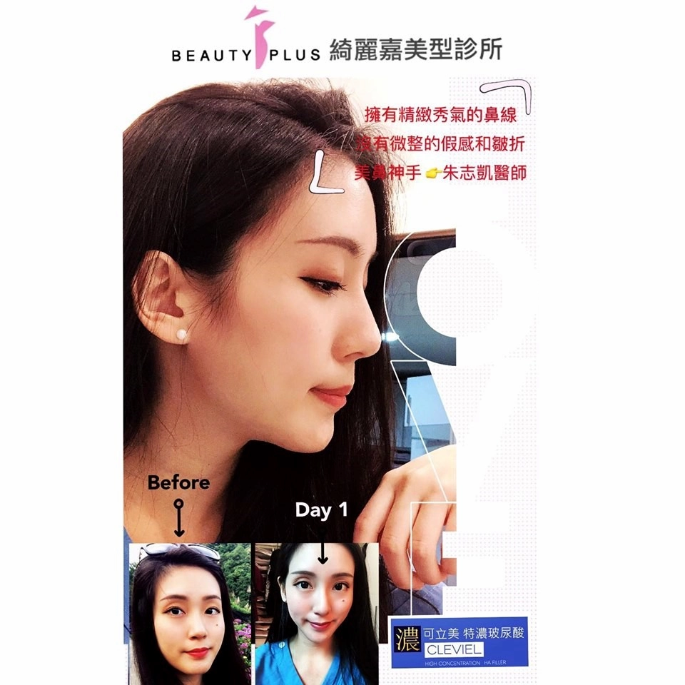 高挺鼻梁見證 高挺鼻梁見證
