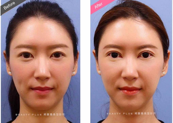 開眼頭手術案例3